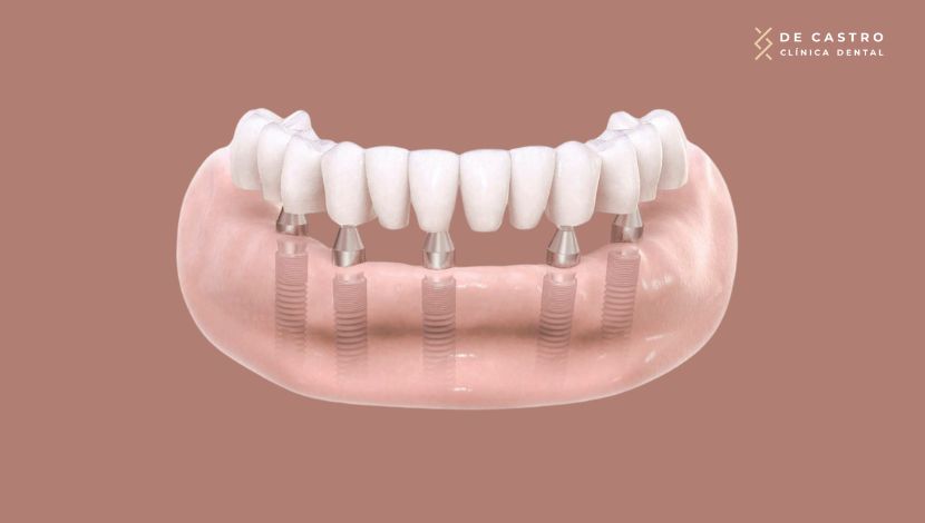 Implantes dentales de carga inmediata