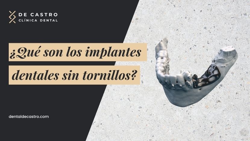 Implantes dentales sin tornillo: ¿Cuándo se recomiendan? (Precios actualizados)
