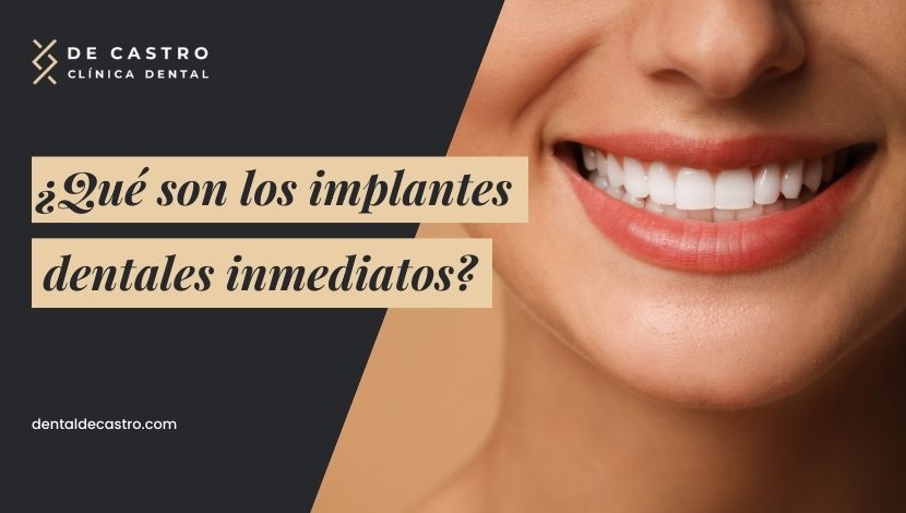 ¿Qué son los implantes dentales inmediatos?