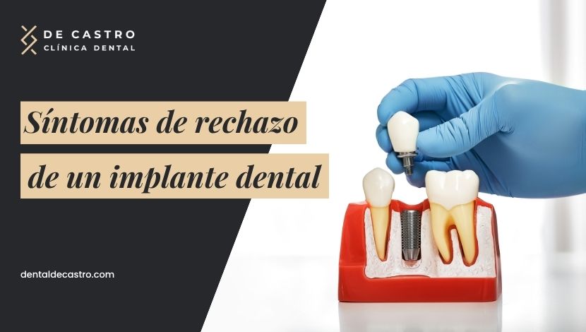 Estos son los 6 principales síntomas del rechazo de un implante dental