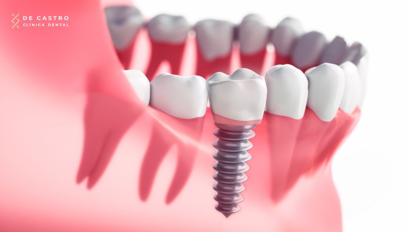 Implantes de carga inmediata