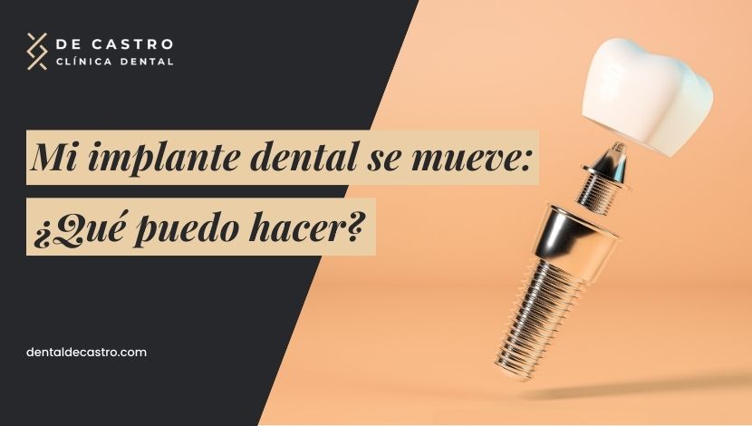 Mi implante dental se mueve: ¿qué puedo hacer?