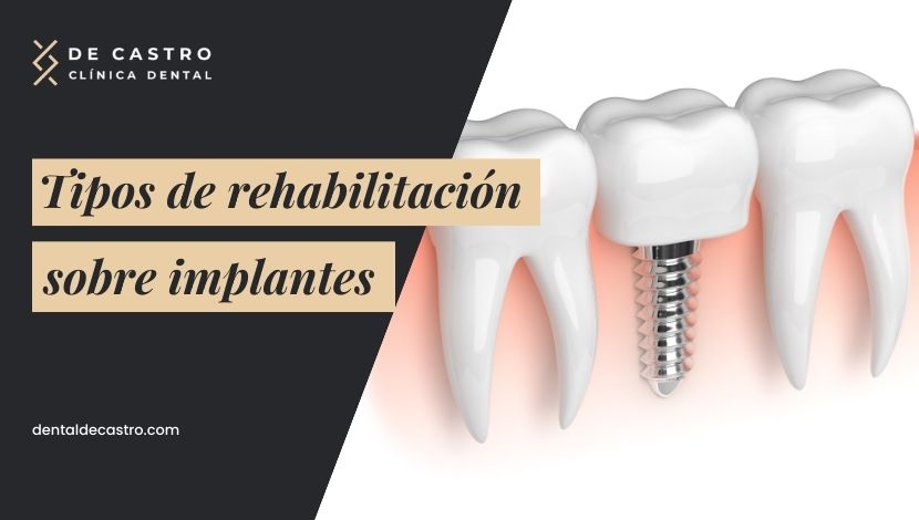 Tipos de rehabilitación sobre implantes