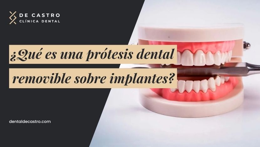 ¿Qué es una prótesis dental removible sobre implantes?