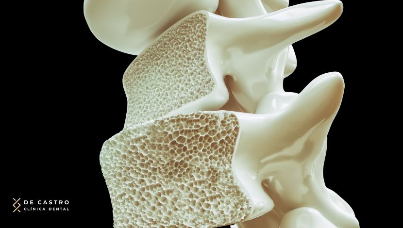 La osteoporosis no impide colocarse implantes dentales