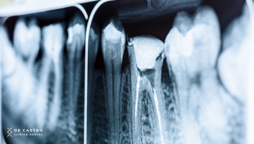 Cómo se hace una endodoncia paso a paso