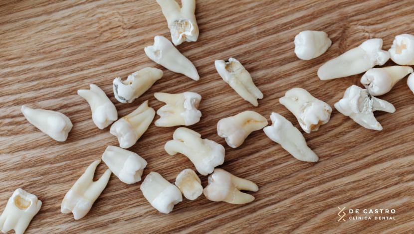 Cuándo necesitas una endodoncia