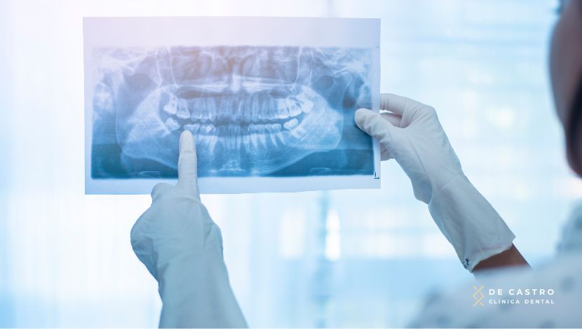 Hábitos y factores funcionales que generan asimetría mandibular