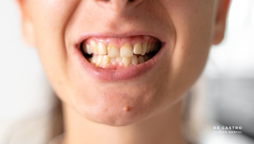 Mandícula retrognática