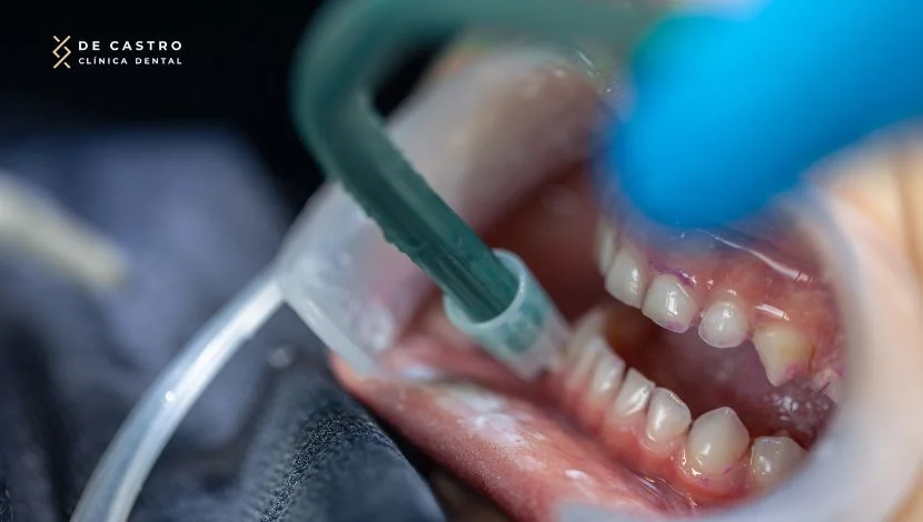 Precios reendodoncia