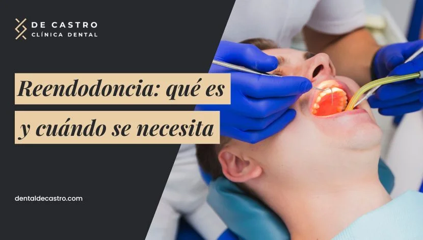 Reendodoncia: qué es y cuándo se necesita