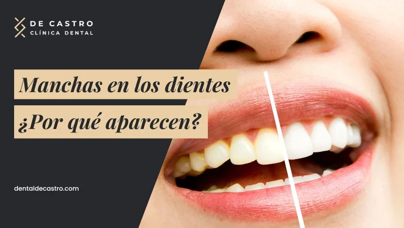 Manchas en los dientes