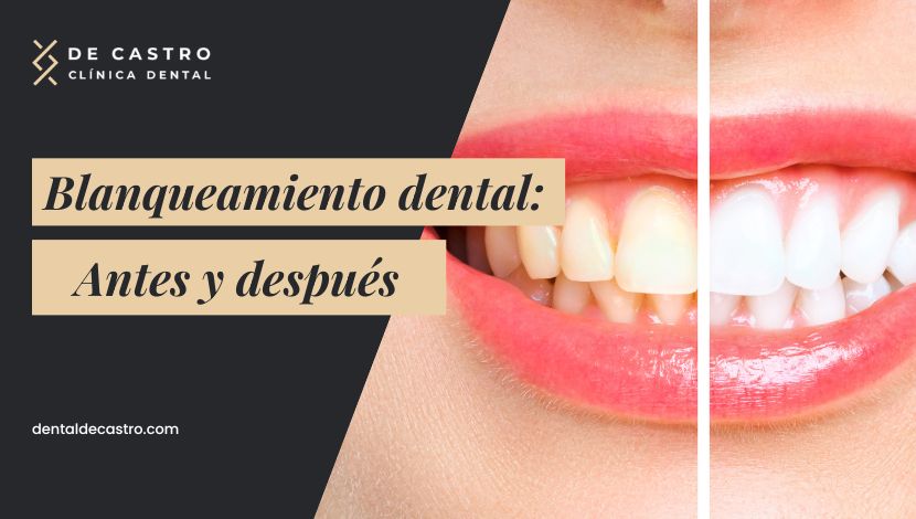 Blanqueamiento dental antes y después: resultados reales y qué esperar