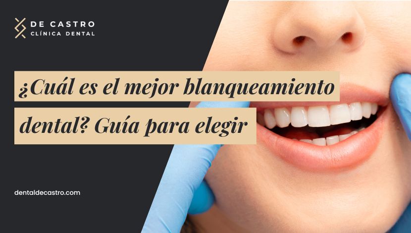 ¿Cuál es el mejor blanqueamiento dental profesional? Comparativa y claves