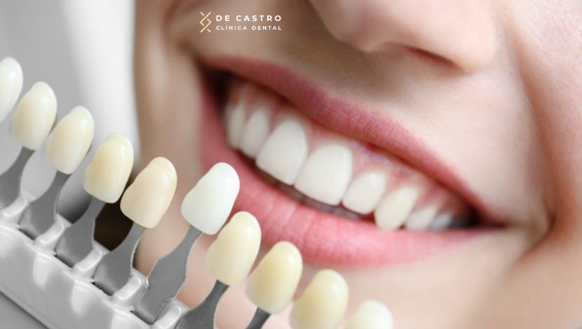 Principales ventajas del blanqueamiento dental